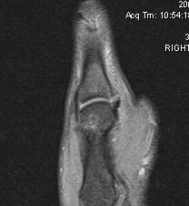 Torn UCL Minimally Displaced MRI